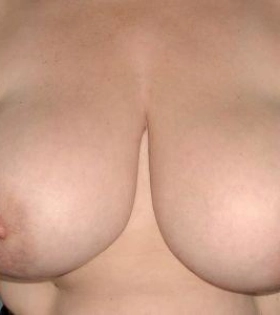 Уменьшение груди - фото до