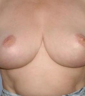 Уменьшение груди - фото після