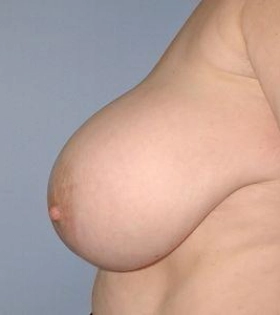 Уменьшение груди - фото до