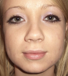 Ринопластика ноздрей  - фото до