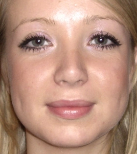 Ринопластика ноздрей  - фото після