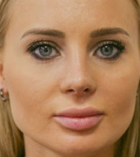 Ринопластика ноздрей  - фото після