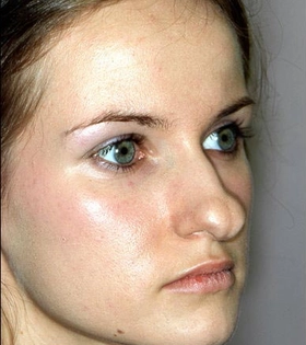 Ринопластика кончика носа - фото до