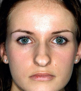 Ринопластика кончика носа - фото до