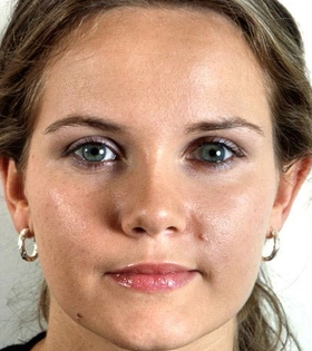 Ринопластика кончика носа - фото після