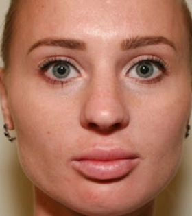 Ринопластика ноздрей - фото до