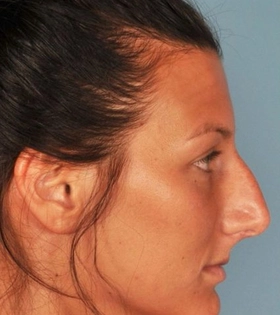 Удаление горбинки носа - фото до