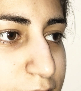 Удаление горбинки носа - фото до