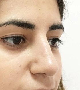 Удаление горбинки носа - фото після