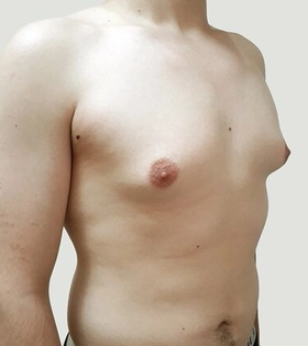 Гинекомастия - фото до
