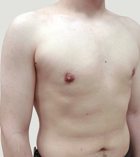 Гинекомастия - фото після