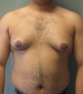 Гинекомастия - фото до