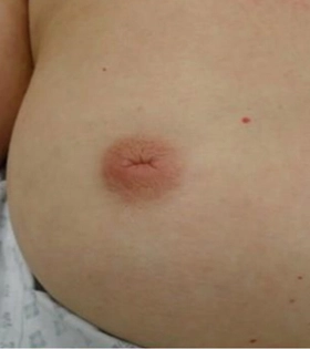 Коррекция сосков - фото до