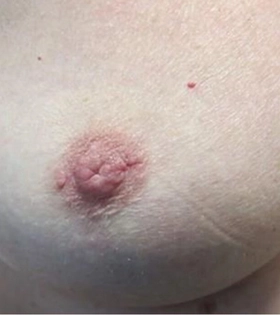 Коррекция сосков - фото після