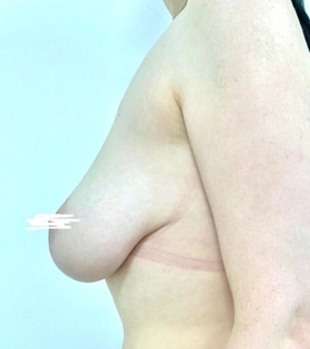 Уменьшение груди якорным разрезом  хирург Бука Г.Ю. - фото до