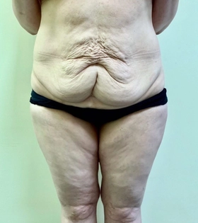 Абдоминопластика  Хирург Бука Г.Ю. - фото до