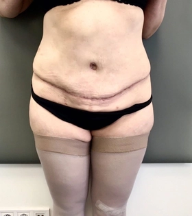 Абдоминопластика  Хирург Бука Г.Ю. - фото після