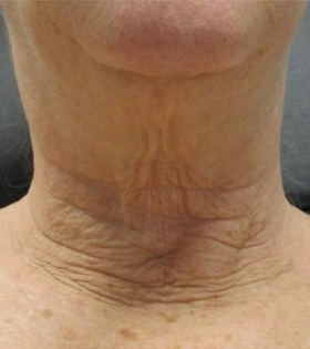 Микроигольчатый RF лифтинг_шея - фото до