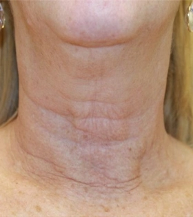 Микроигольчатый RF лифтинг_шея - фото після