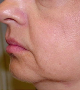 Радиоволновой рф лифтинг - фото до