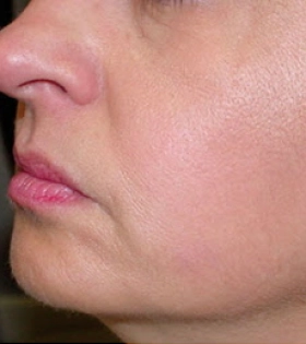 Радиоволновой рф лифтинг - фото після