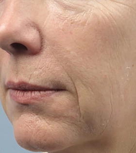 Радиоволновой  RF лифтинг - фото до