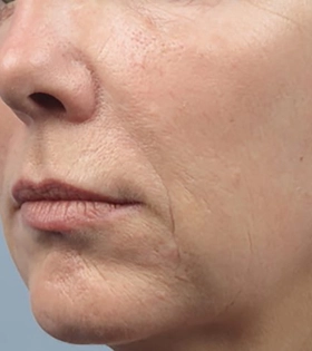 Радиоволновой  RF лифтинг - фото після