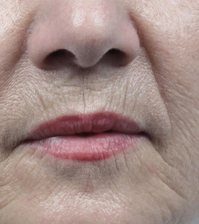 Радиоволновой  RF лифтинг - фото до