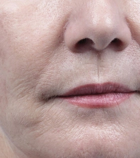 Радиоволновой  RF лифтинг - фото після