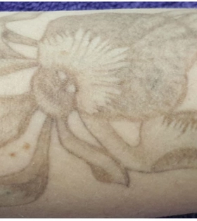 Удаление татуировки. Результат после 1 сеанса. Врач Максюта О.А. - фото після