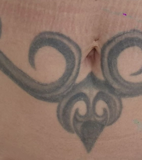 Удаление татуировки. Результат после 1 сеанса. Врач Максюта О.А. - фото до