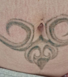 Удаление татуировки. Результат после 1 сеанса. Врач Максюта О.А. - фото після