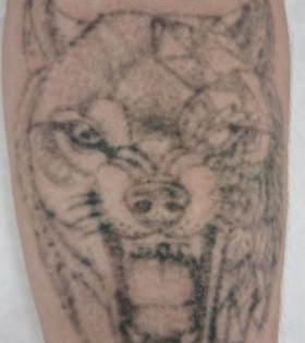 Удаление татуировки. Результат после 3 сеансов. Врач Максюта О.А. - фото після