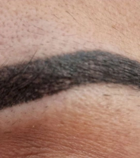 Удаление татуажа бровей. Результат после 1 сеанса. Врач Максюта О.А. - фото до