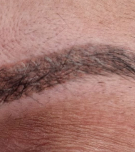 Удаление татуажа бровей. Результат после 1 сеанса. Врач Максюта О.А. - фото після