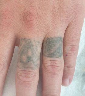 Удаление татуировки. Результат после 1 сеанса. Врач Максюта О.А. - фото до