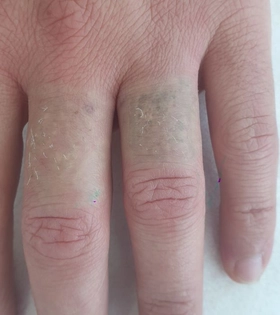 Удаление татуировки. Результат после 1 сеанса. Врач Максюта О.А. - фото після