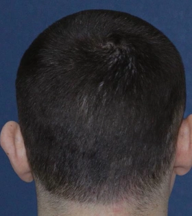 Отопластика. Хирург Саркисян А.Г. - фото до