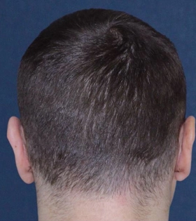 Отопластика. Хирург Саркисян А.Г. - фото після