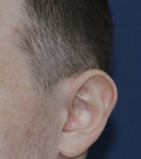 Отопластика. Хирург Саркисян А.Г. - фото до