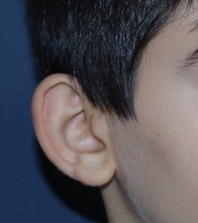 Отопластика. Хирург Саркисян А.Г. - фото до