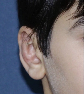 Отопластика. Хирург Саркисян А.Г. - фото після