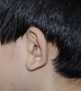 Отопластика. Хирург Саркисян А.Г. - фото до