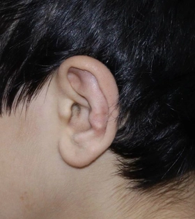 Отопластика. Хирург Саркисян А.Г. - фото після