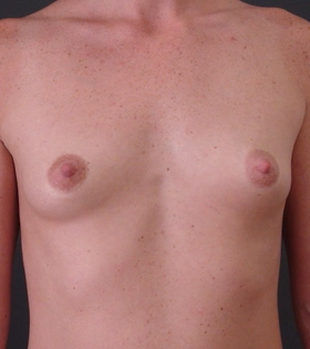 Увеличение груди имплантами. Хирург Саркисян А.Г. - фото до