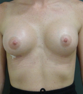 Увеличение груди имплантами. Хирург Саркисян А.Г. - фото після