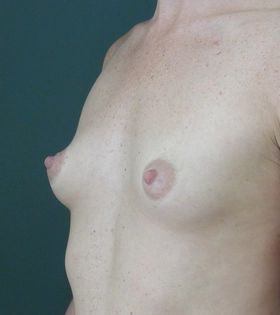 Увеличение груди имплантами. Хирург Саркисян А.Г. - фото до