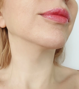 Ультразвукова Vaser ліпосакція підборіддя та брилів - фото після