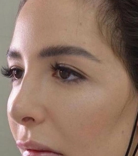 Кантопластика - фото до