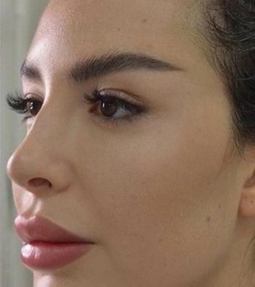 Кантопластика - фото після